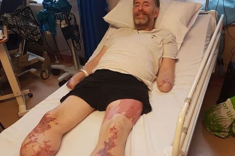 Chris perdeu parte dos braços e das pernas