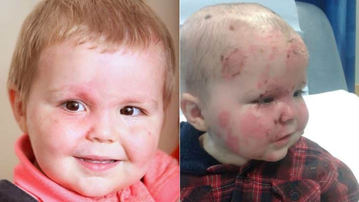 Mãe faz alerta após filho ter graves queimaduras Mãe faz alerta após filho ter graves queimaduras