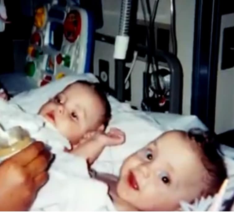 Gêmeas siamesas Gêmeas siamesas