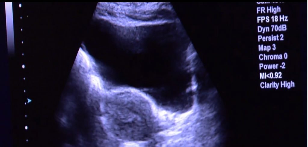 Mulher recebe útero de doadora morta e dá à luz