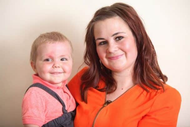 Mãe faz alerta após filho ter graves queimaduras Mãe faz alerta após filho ter graves queimaduras