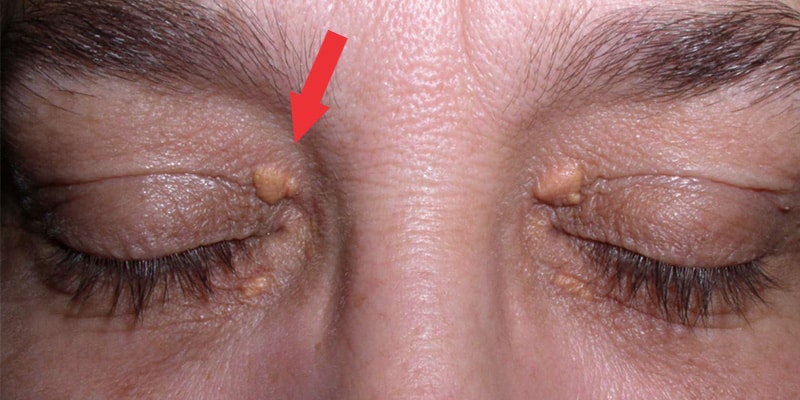 Saiba como tratar o xantelasma