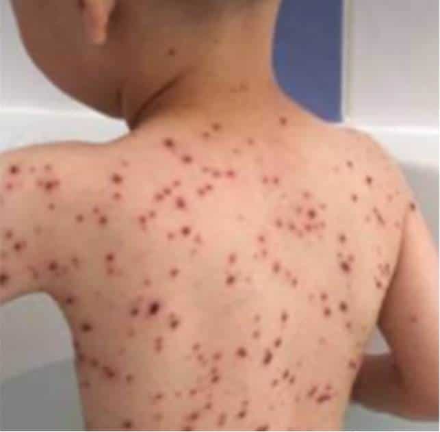 Mãe alerta sobre uso do ibuprofeno