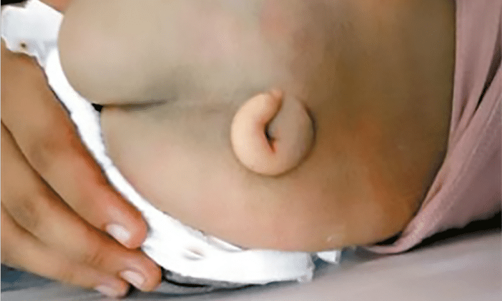 Falta de vitamina faz bebê nascer com "cauda de porco"