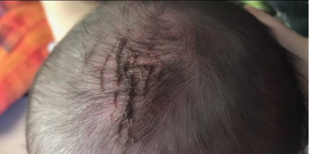 Bebê sofre com perfurações na cabeça durante parto