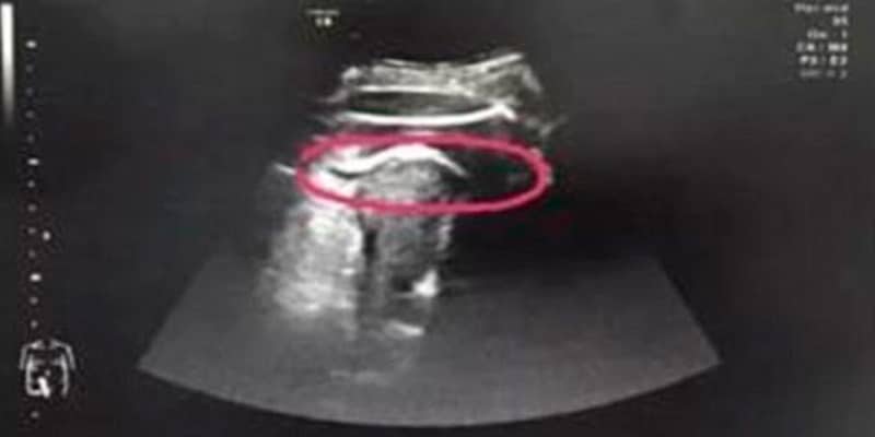 Com fortes dores abdominais, mãe procura médico e descobre que bebê rompeu seu útero