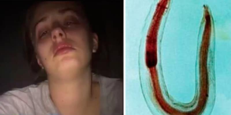 Parasita causa agonia por seis anos. E jovem faz alerta sobre o perigo do peixe cru