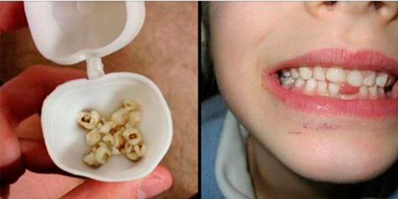 Médicos estão implorando para que todos os pais guardem o dente de leite de seus filhos