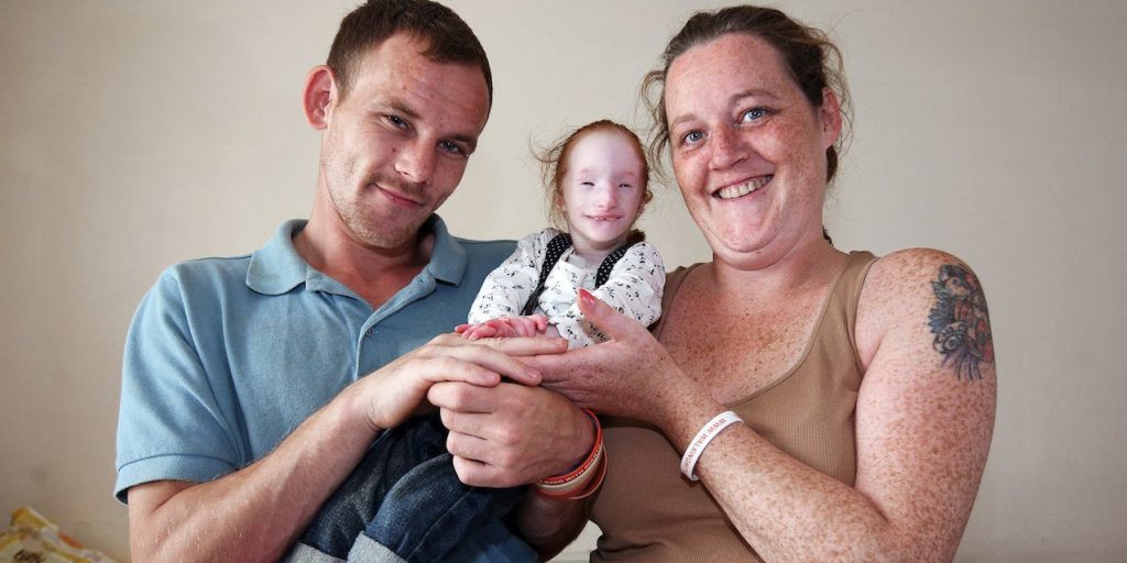 Superando os prognósticos, menina que nasceu com tipo raro de nanismo tem aparência similar a de uma boneca de porcelana.
