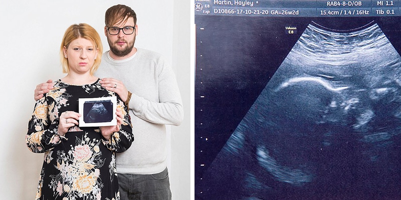 Mãe descobre que bebê nascerá morta e decide continuar gravidez por um motivo especial