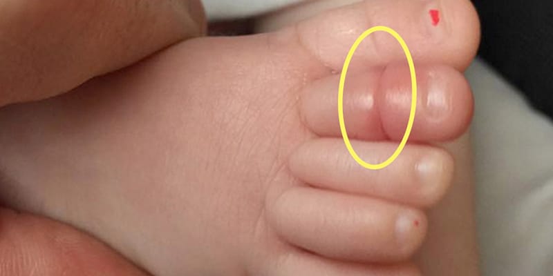 Fio de cabelo fica preso em dedo de bebê. Agora, ele poderá precisar amputar o membro