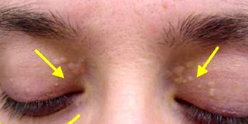 Se notar marcas como essa em seus olhos, fique em alerta. Elas podem esconder sérios problemas