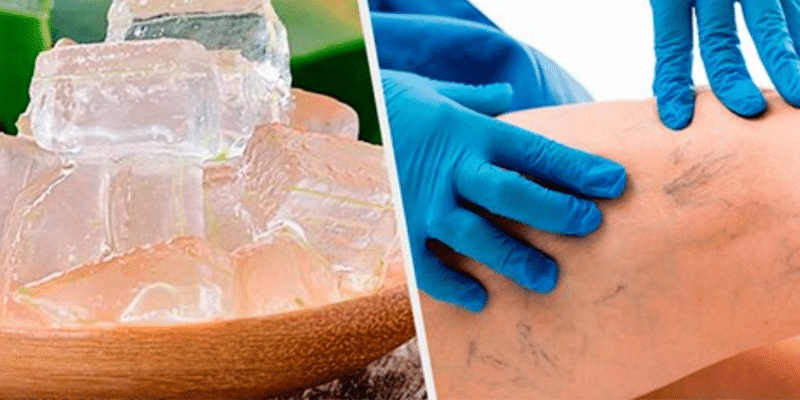 Reative a circulação e acabe com as varizes com esse remédio caseiro. Veja a receita