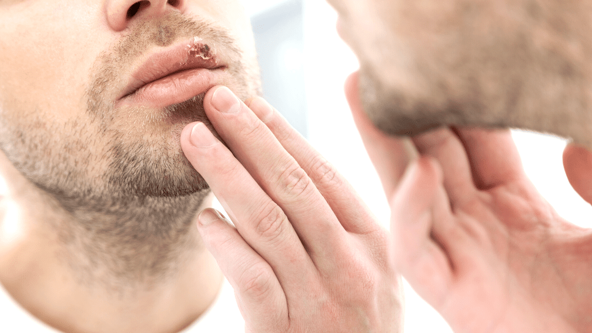 Vamos falar de herpes sim! Cuide-se.