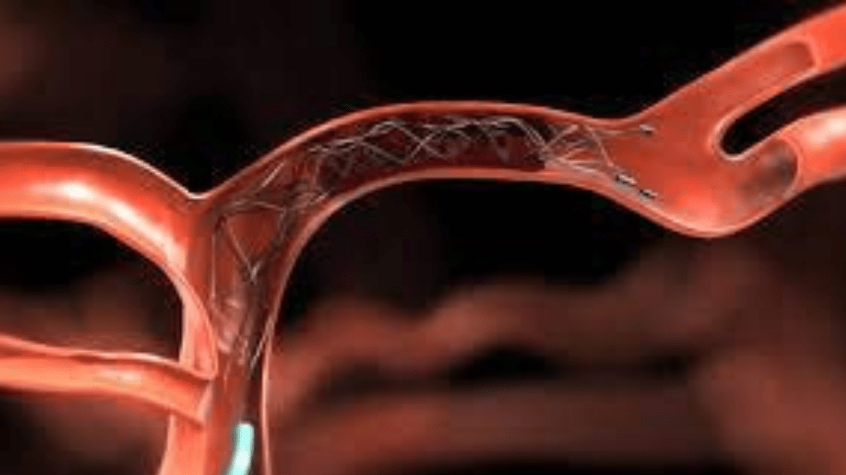 SUS adota tratamento avançado contra AVC